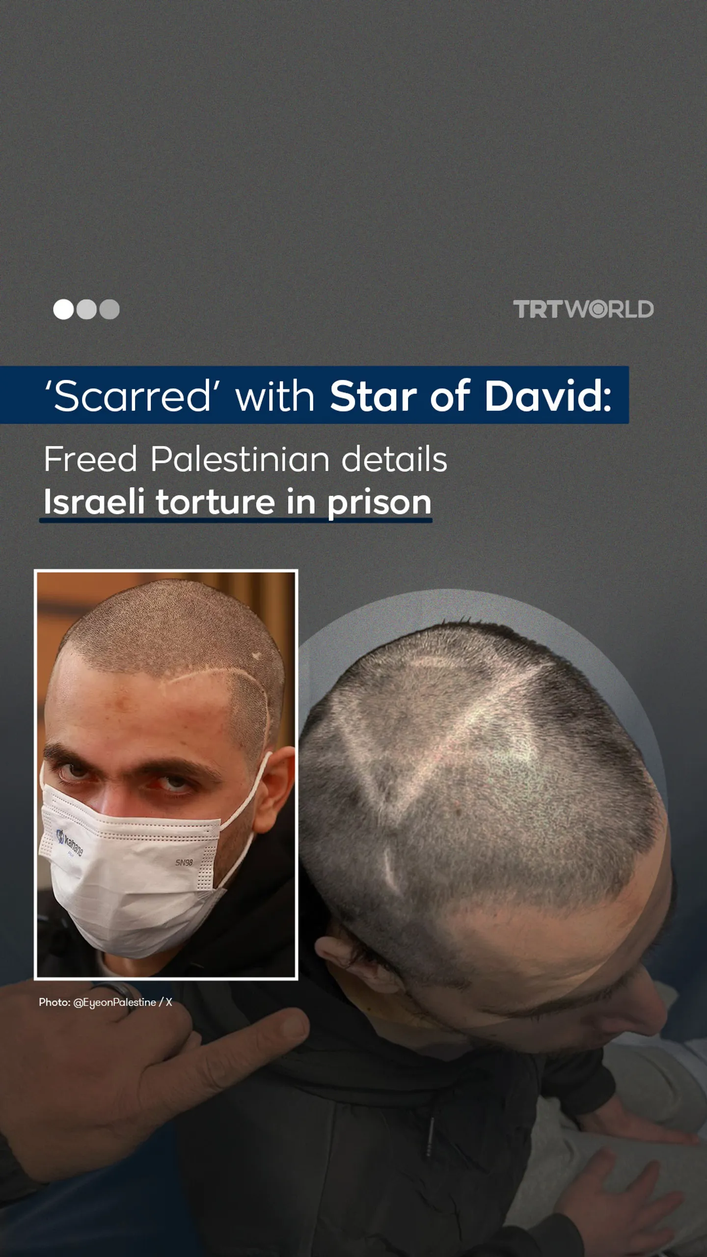 ‘Scarred’ with Star of David: Freed Palestinian details Israeli torture in prison